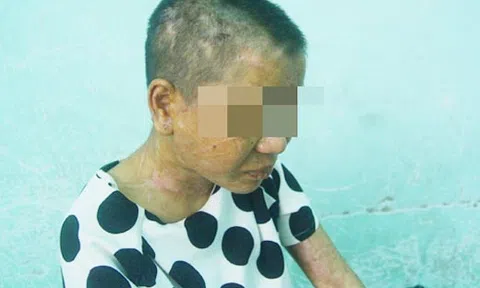 Cô gái bị tra tấn dã man ở Gia Lai kể lại hành trình thoát khỏi “địa ngục trần gian”